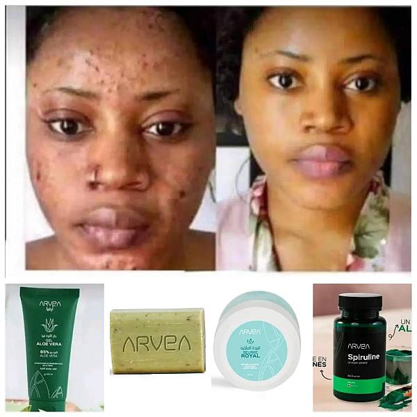 Promotion sur Aloe Vera Savon miracle contre bouton